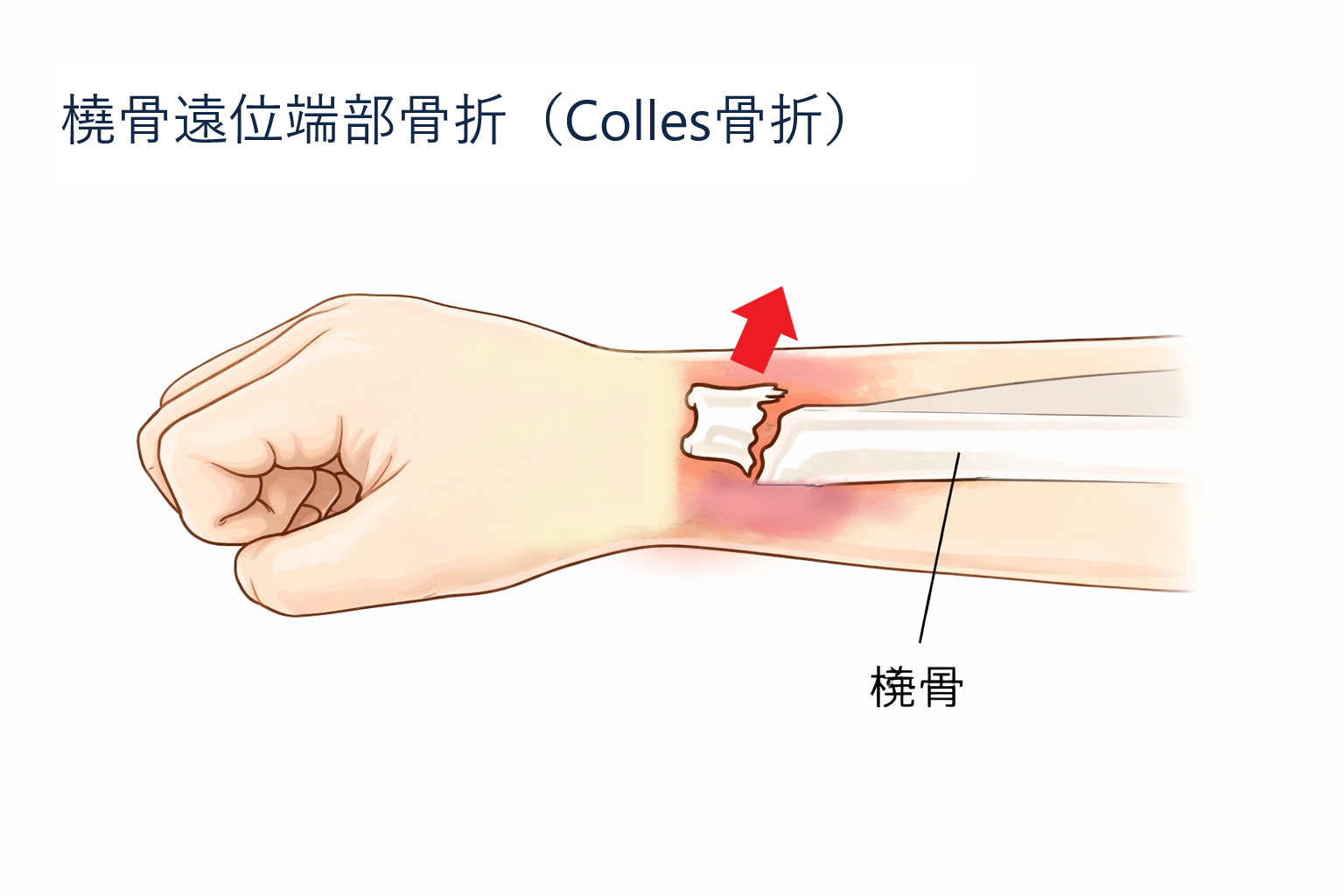 コーレス骨折を示すイメージ図