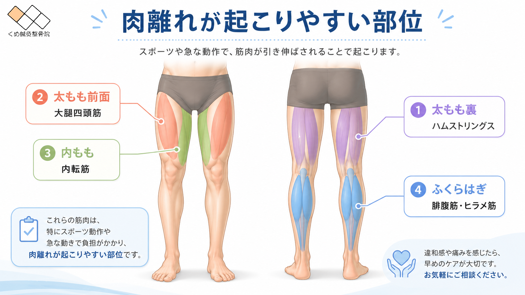 太もも裏・太もも前面・内もも・ふくらはぎなど、肉離れが起こりやすい部位を示した、くめ鍼灸整骨院の解説図