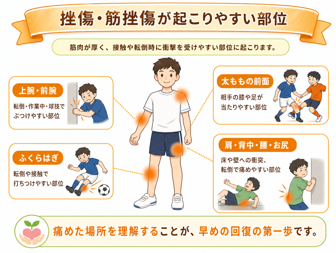 挫傷・筋挫傷が起こりやすい部位として、上腕・前腕、太ももの前面、ふくらはぎ、肩・背中・腰・お尻を示すイラスト